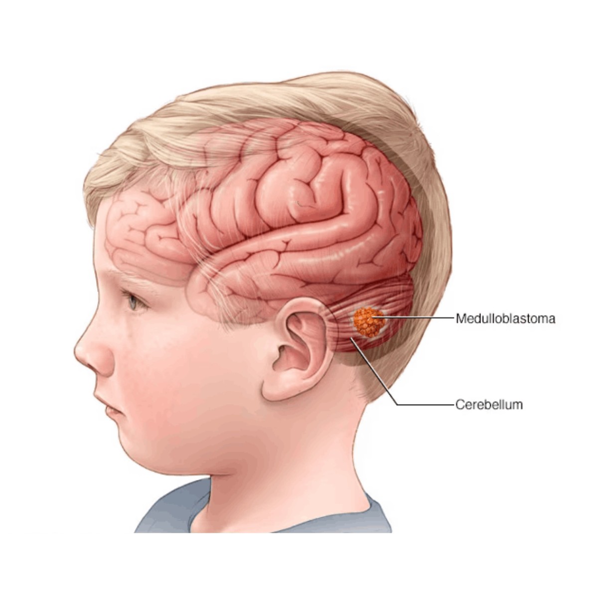 Medulloblastoma