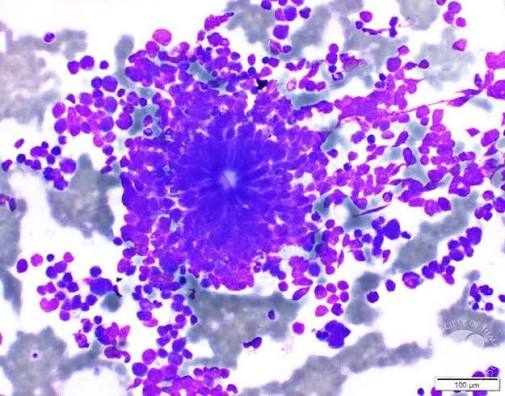 Neuroblastoma